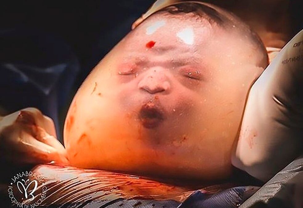 Μια φορά στις 100.000: Μωρό γεννήθηκε μέσα στον αμνιακό σάκο