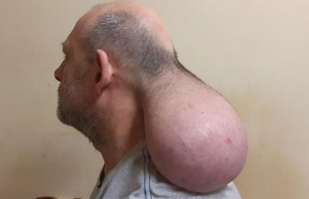 Σέρρες: Κραυγή απόγνωσης από κρατούμενο με τεράστιο όγκο στο κεφάλι (ΦΩΤΟ)