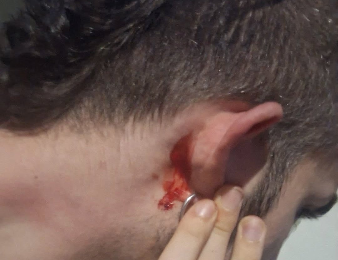 Ομοφοβική επίθεση στην Ανθούπολη: Τι καταγγέλλει το 24χρονο θύμα της επίθεσης